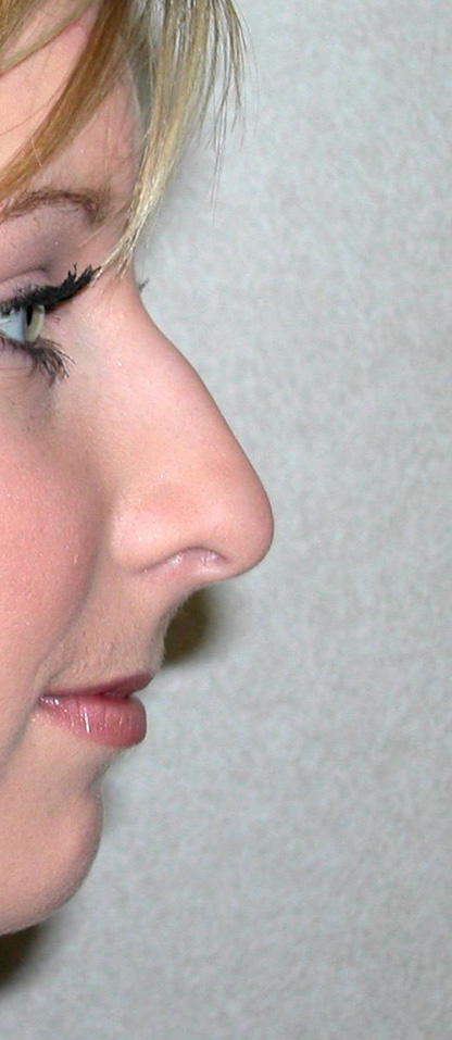 Rhinoplasty