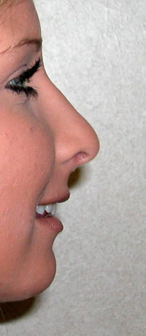 Rhinoplasty Case 7939 After Photo Rhinoplasty