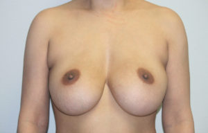 Breast Revision Case 7970 Before Photo Breast Revision