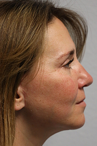 Forehead, Face and Neck Lift