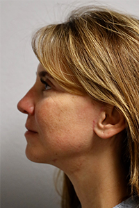 Forehead, Face and Neck Lift