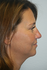 Forehead, Face and Neck Lift