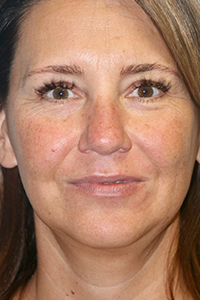 Forehead, Face and Neck Lift