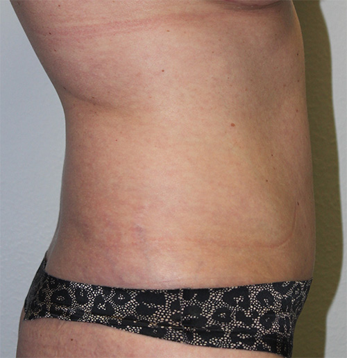 Tummy Tuck (Abdominoplasty)