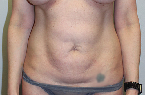 Tummy Tuck (Abdominoplasty)