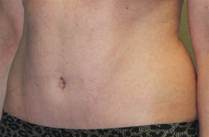 Tummy Tuck (Abdominoplasty)