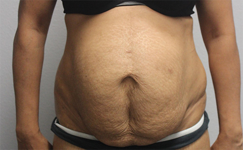 Tummy Tuck (Abdominoplasty)