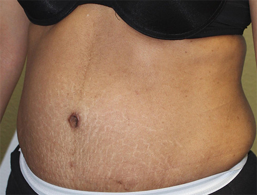 Tummy Tuck (Abdominoplasty)