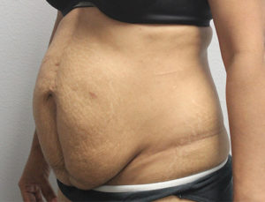 Tummy Tuck (Abdominoplasty)