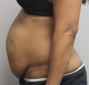 Tummy Tuck (Abdominoplasty)