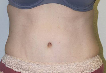 Tummy Tuck (Abdominoplasty)