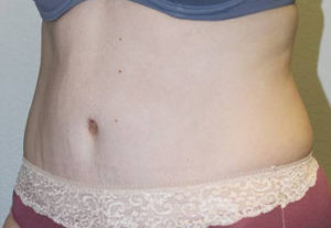 Tummy Tuck (Abdominoplasty)