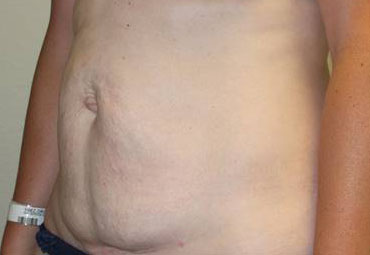 Tummy Tuck (Abdominoplasty)