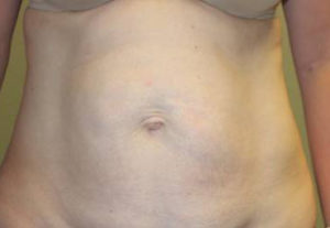 Tummy Tuck (Abdominoplasty)