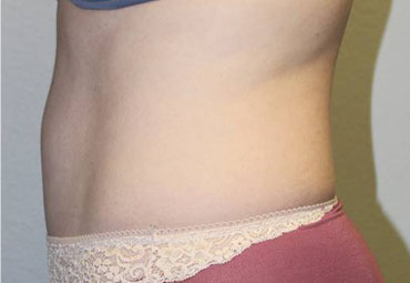 Tummy Tuck (Abdominoplasty)