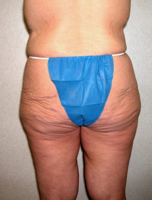 Buttock and ThighLift Case 8133 Before Photo Buttock and ThighLift