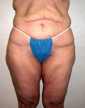 Buttock and ThighLift Case 8133 Before Photo Buttock and ThighLift