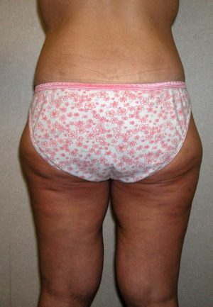Buttock and ThighLift Case 8133 After Photo Buttock and ThighLift