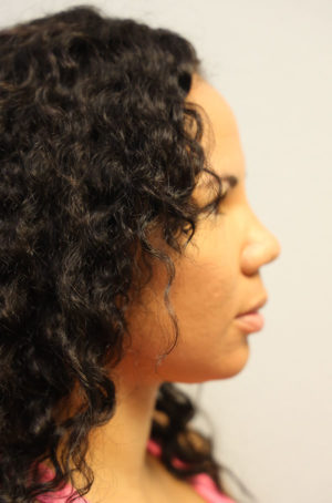 Rhinoplasty Case 8282 After Photo Rhinoplasty