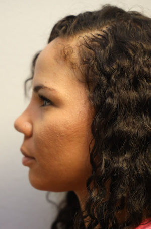 Rhinoplasty Case 8282 After Photo Rhinoplasty
