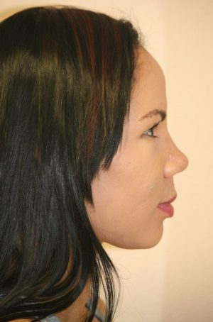 Rhinoplasty