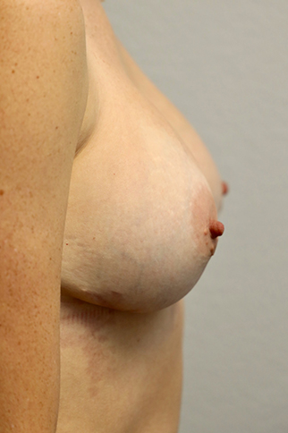 Breast Revision