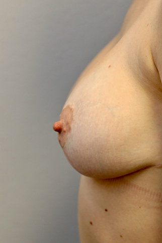 Breast Revision