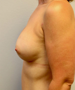 Breast Augmentation