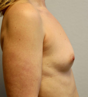 Breast Augmentation