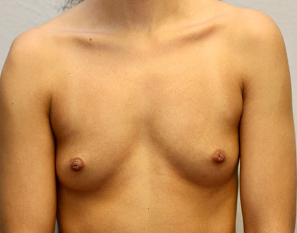 Breast Augmentation