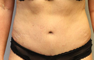 Tummy Tuck (Abdominoplasty)