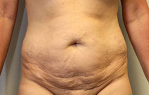 Tummy Tuck (Abdominoplasty)