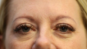  Eyelid Surgery (Blepheroplasty)