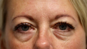  Eyelid Surgery (Blepheroplasty)