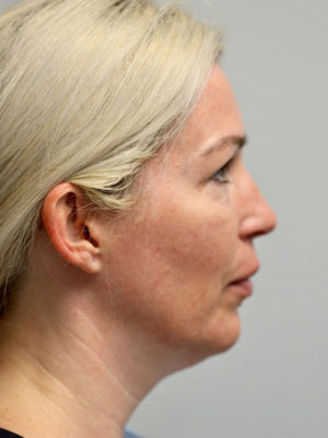 Forehead, Face and Neck Lift