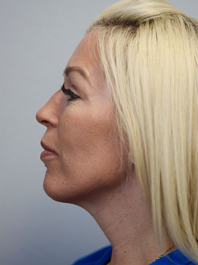 Forehead, Face and Neck Lift