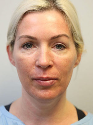 Forehead, Face and Neck Lift Case 8726 Before Photo Forehead, Face and Neck Lift