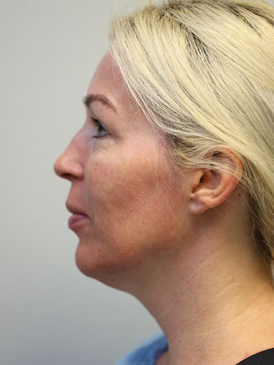 Forehead, Face and Neck Lift