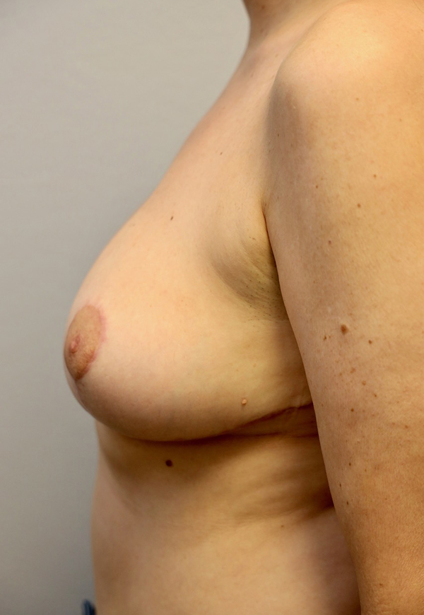 Breast Reduction