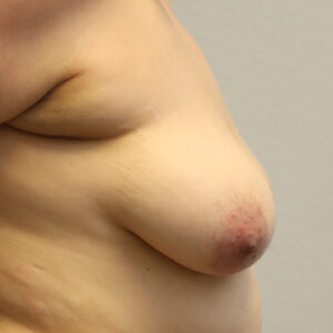 Breast Enhancements