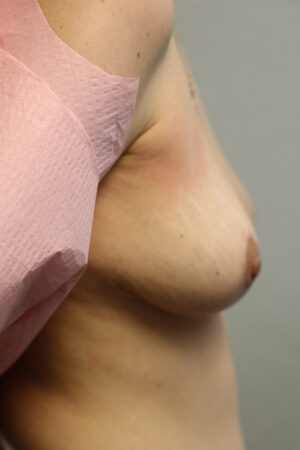 Breast Enhancements