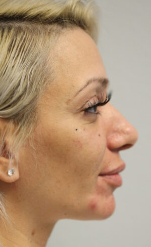 Rhinoplasty