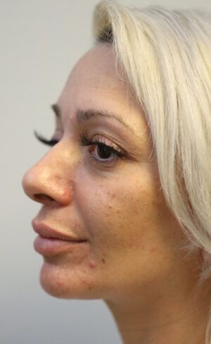 Rhinoplasty Case 8967 Before Photo Rhinoplasty