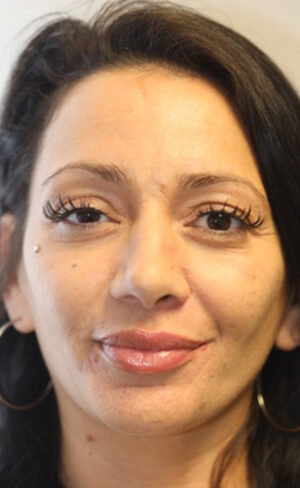 Rhinoplasty Case 8967 After Photo Rhinoplasty