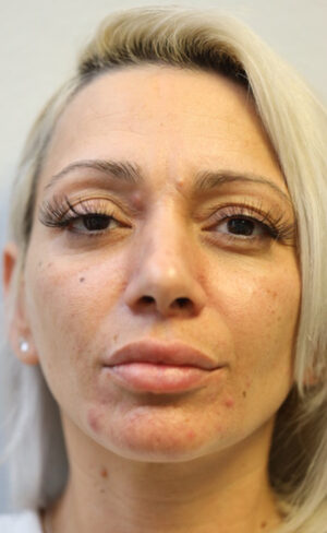 Rhinoplasty Case 8967 Before Photo Rhinoplasty