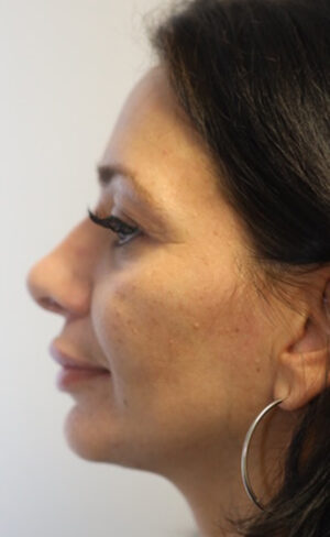 Rhinoplasty Case 8967 After Photo Rhinoplasty