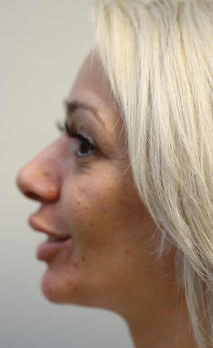 Rhinoplasty