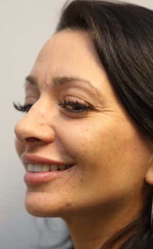 Rhinoplasty Case 8967 After Photo Rhinoplasty