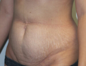 Tummy Tuck (Abdominoplasty)