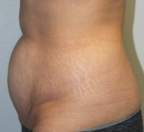 Tummy Tuck (Abdominoplasty)